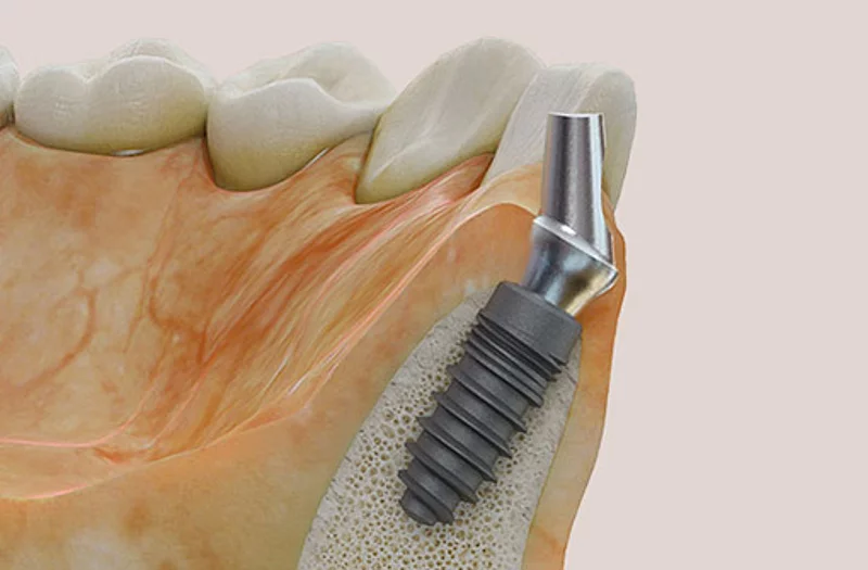 Inseriertes Titanimplantat mit anguliertem Abutment
