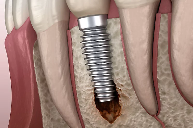 Periimplantitis mit sichtbarer Knochenschädigung. Medizinisch korrekte 3D-Darstellung des Konzepts von Zahnimplantaten