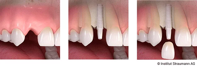 Keramikimplantate sind eine metallfreie Alternative zu Titanimplantaten. 